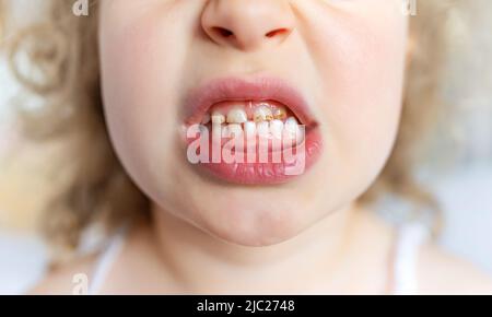 Karies und Plaque auf Kinderzähnen. Stockfoto