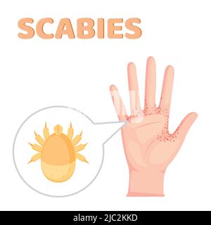 Sarcoptes scabiei. Scabies. Sexuell übertragbare Krankheit. Infografiken. Illustration auf isoliertem Hintergrund. Stock Vektor