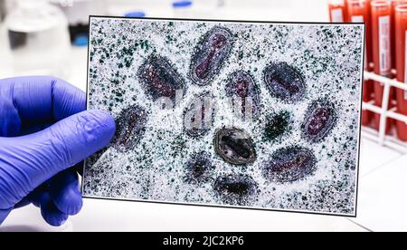 Apothekerhand mit Latexhandschuh mit Monkeypox-Impfstoff und Pockenviruspoto im Hintergrund Stockfoto
