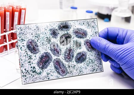 Apothekerhand mit Latexhandschuh mit Monkeypox-Impfstoff und Pockenviruspoto im Hintergrund Stockfoto