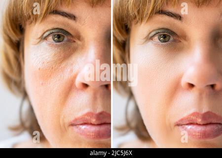 Foto von Anti-aging-Verfahren auf kaukasische Frau Gesicht Stockfoto