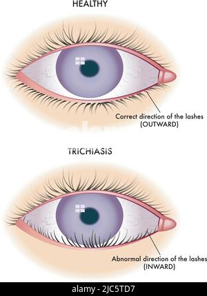 Die medizinische Illustration zeigt den Vergleich zwischen einem normalen Auge und einem von Trichiasis betroffenen Auge. Stock Vektor