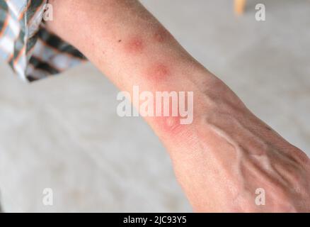 Allergische Reaktion auf Insektenstiche mit runden Schwellstellen am Arm einer Frau Stockfoto