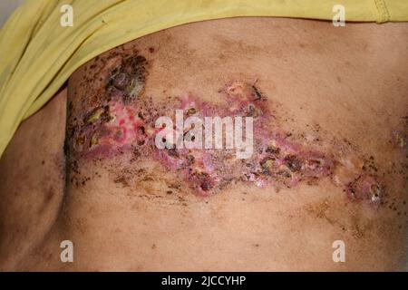 Herpes-Simplex-Infektion an Brust und Bauch des asiatischen Mannes. Stockfoto