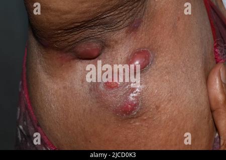 Große Karbunkel oder Abszesse an der Axilla einer weiblichen Patientin aus Asien-Burma. Stockfoto