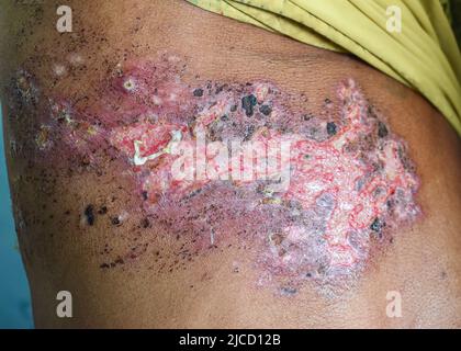 Herpes-Simplex-Infektion an Brust und Bauch des asiatischen Mannes. Stockfoto