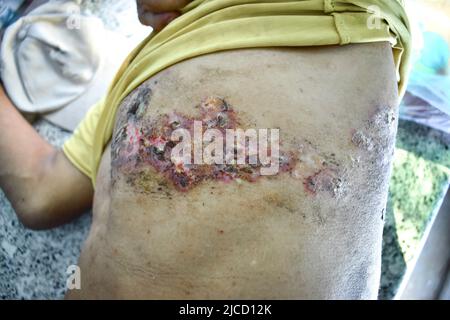 Herpes-Simplex-Infektion an Brust und Bauch des asiatischen Mannes. Stockfoto