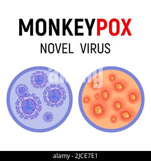 Monkeypox-Viruszellen und menschliche Haut mit Hautausschlag, Wunden und Geschwüren auf weißem Hintergrund in Nahaufnahme. Monkeypox-Virus-Symptom. Vektorgrafik. Stock Vektor