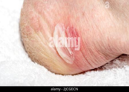 Fuß mit Hornhaut auf einem weißen Handtuch, Nahaufnahme. Rote Schmerzen am Bein durch das Tragen von Schuhen. Blutiger Callus an der Ferse. Trockene Haut an den Füßen mit Rissen, Peeling Stockfoto