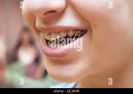 Nahaufnahme des Mundes einer jungen kaukasischen Dame, die Zahnspangen oder Klammern trägt. Ihre kieferorthopädische Behandlung besteht aus keramischen Zahnspangen Stockfoto