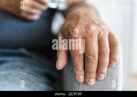 Älterer Mann, der an Psoriasis leidet, Nahaufnahme der Hände Stockfoto