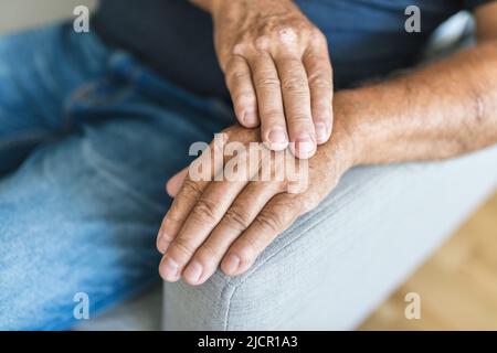 Älterer Mann, der an Psoriasis leidet, Nahaufnahme der Hände Stockfoto