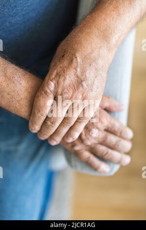 Älterer Mann, der an Psoriasis leidet, Nahaufnahme der Hände Stockfoto