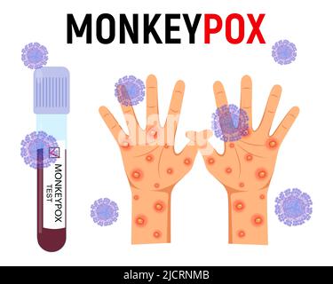 Affenpocken Hintergrund. Ein Reagenzglas mit Blut für einen Test und eine menschliche Hand mit einem Ausschlag und Geschwüren, umgeben von Viruszellen auf weißem Hintergrund Stock Vektor