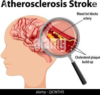 Menschliche Anatomie mit Darstellung eines Atherosklerose-Schlaganfalls Stock Vektor