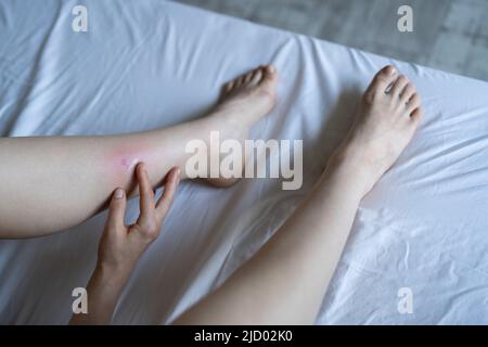 Mädchen, das zu Hause auf dem Bett sitzt und Creme auf geschwollenes Hautbein von Mückenstichen oder Mückenstichen auftragen. Allergie Stockfoto