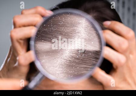 Nahaufnahme einer Schuppe In blonden Haaren gesehen, durch Lupe Stockfoto