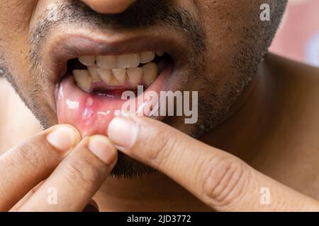 Nahaufnahme eines Mundgeschwürs eines indischen Mannes Stockfoto