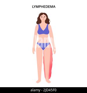 Lymphodem Beinschwellung, Illustration Stockfoto