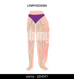 Lymphodem Beinschwellung, Illustration Stockfoto