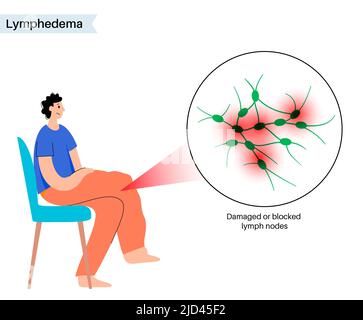 Lymphodem Beinschwellung, Illustration Stockfoto