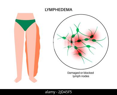 Lymphodem Beinschwellung, Illustration Stockfoto