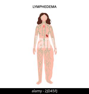 Lymphodem Beinschwellung, Illustration Stockfoto