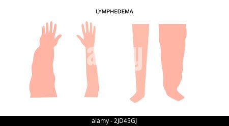 Lymphodem von Arm und Bein, Illustration Stockfoto