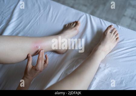 Mädchen, das zu Hause auf dem Bett sitzt und Creme auf geschwollenes Hautbein von Mückenstichen oder Mückenstichen auftragen. Allergie Stockfoto