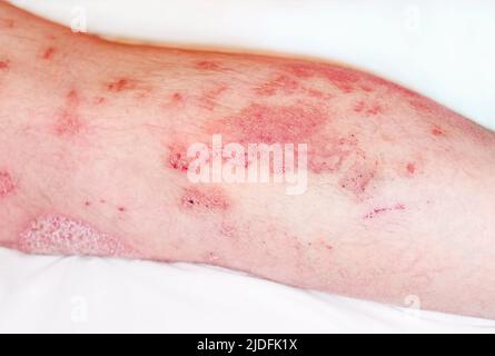 Große rote, entzündete, schuppige Hautausschläge an den Beinen des Mannes.akute Psoriasis, starke Rötung der Haut, eine autoimmune, unheilbare dermatologische Hauterkrankung.Gelenke Stockfoto