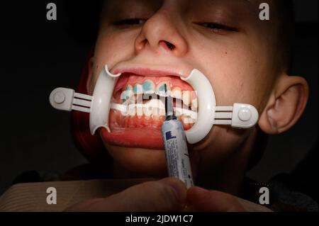 Ivano-Frankivsk, Ukraine 3. Februar 2022: Leim auf die Zähne auftragen, um Zahnspangen zu kleben, Zähne mit Zahnspangen ausrichten, Basis für Zahnspangen. Stockfoto