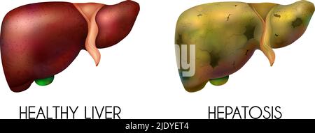 Realistische menschliche innere Organe Leber gesund normale ungesunde Fettzusammensetzung mit zwei verschiedenen Farben, wenn die Krankheit vorhanden ist Vektor illustraa Stock Vektor