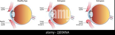 Die medizinische Illustration zeigt den Vergleich zwischen einem normalen Auge, einem von Entropium und einem anderen von Ektropium betroffen. Stock Vektor
