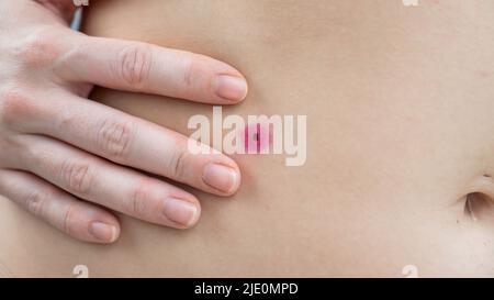 Nahaufnahme einer entfernten Warze am Bauch einer Frau. Humanes Papillomavirus nach dem Brennen. Stockfoto