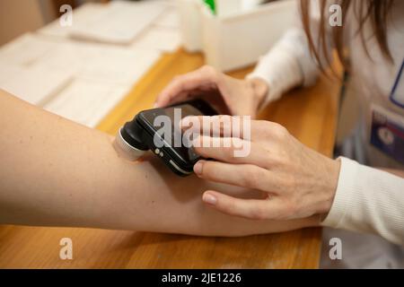 Arzt Dermatologe untersucht Muttermale und Muttermale an der Hand einer weiblichen Patientin. Nahaufnahme eines zugeschnittenen Bildes der Untersuchung von Muttermalen mit einem modernen Gerät Stockfoto