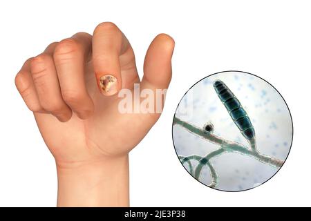 Illustration einer Nagel-Pilzinfektion mit einer menschlichen Hand mit Onychomykose und Nahaufnahme von Trichopyton-Mentagrophyten-Pilzen, einem der ursächlichen Erreger von Nagel-Infektionen. Stockfoto