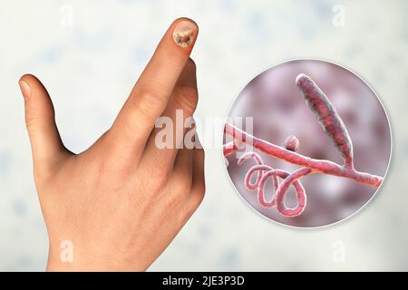 Illustration einer Nagel-Pilzinfektion mit einer menschlichen Hand mit Onychomykose und Nahaufnahme von Trichopyton-Mentagrophyten-Pilzen, einem der ursächlichen Erreger von Nagel-Infektionen. Stockfoto