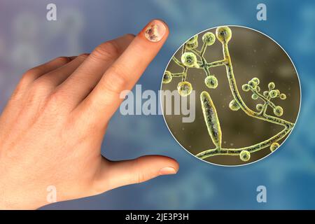 Illustration einer Nagel-Pilzinfektion mit einer menschlichen Hand mit Onychomykose und Nahaufnahme von Trichopyton-Mentagrophyten-Pilzen, einem der ursächlichen Erreger von Nagel-Infektionen. Stockfoto