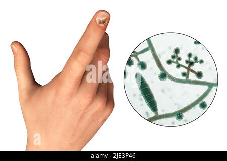 Illustration einer Nagel-Pilzinfektion mit einer menschlichen Hand mit Onychomykose und Nahaufnahme von Trichopyton-Mentagrophyten-Pilzen, einem der ursächlichen Erreger von Nagel-Infektionen. Stockfoto