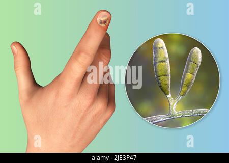 Illustration einer Nagel-Pilzinfektion mit einer menschlichen Hand mit Onychomykose und Nahaufnahme von Epidermophyton floccosum-Pilzen, einem der ursächlichen Erreger von Nagel-Infektionen. Stockfoto