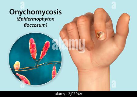 Illustration einer Nagel-Pilzinfektion mit einer menschlichen Hand mit Onychomykose und Nahaufnahme von Epidermophyton floccosum-Pilzen, einem der ursächlichen Erreger von Nagel-Infektionen. Stockfoto