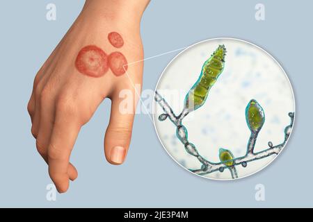 Pilzinfektion an der Hand eines Mannes, Illustration. Bekannt als Ringwurm-Infektion oder Tinea manuum. Es kann durch verschiedene Pilze, einschließlich Microsporum audouinii, verursacht werden. Es verursacht starken Juckreiz. Die Krankheit ist hochansteckend und kann durch direkten Kontakt oder durch Kontakt mit kontaminiertem Material verbreitet werden. Die Behandlung erfolgt mit Antimykotika. Stockfoto