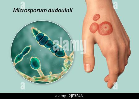 Pilzinfektion an der Hand eines Mannes, Illustration. Bekannt als Ringwurm-Infektion oder Tinea manuum. Es kann durch verschiedene Pilze, einschließlich Microsporum audouinii, verursacht werden. Es verursacht starken Juckreiz. Die Krankheit ist hochansteckend und kann durch direkten Kontakt oder durch Kontakt mit kontaminiertem Material verbreitet werden. Die Behandlung erfolgt mit Antimykotika. Stockfoto