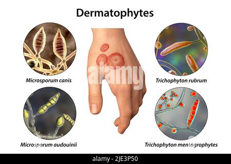 Pilzinfektion an der Hand eines Mannes, Illustration. Bekannt als Ringwurm-Infektion oder Tinea manuum. Es kann durch verschiedene Pilze verursacht werden, darunter Microsporum canis, Microsporum audouinii, Trichophyton rubrum und Trichophyton mentagrophytes. Es verursacht starken Juckreiz. Die Krankheit ist hochansteckend und kann durch direkten Kontakt oder durch Kontakt mit kontaminiertem Material verbreitet werden. Die Behandlung erfolgt mit Antimykotika. Stockfoto