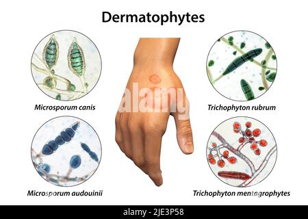 Pilzinfektion an der Hand eines Mannes, Illustration. Bekannt als Ringwurm-Infektion oder Tinea manuum. Es kann durch verschiedene Pilze verursacht werden, darunter Microsporum canis, Microsporum audouinii, Trichophyton rubrum und Trichophyton mentagrophytes. Es verursacht starken Juckreiz. Die Krankheit ist hochansteckend und kann durch direkten Kontakt oder durch Kontakt mit kontaminiertem Material verbreitet werden. Die Behandlung erfolgt mit Antimykotika. Stockfoto