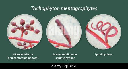 Pilze Trichophyton mentagrophytes, die Ursache des Fußes des Athleten (Tinea pedis), des Kopfhautringwurms (Tinea capitus) und der Nagelinfektion (Onychomykose), Illustration. T. mentagrophytes ist eine von vielen Pilzarten, die in der menschlichen Haut wachsen und Entzündungen und Juckreiz verursachen können. Fußpilz, Ringwurm und Onychomykose werden mit Antimykotika behandelt. Die Abbildung zeigt zwei Arten von Konidien (Strukturen, die Pilzsporen enthalten, die Infektionen übertragen): Verzweigte Konidiophoren mit sphärischen Mikrokonidien (einzellige Körper), Makrokonidium (vielzelliger Körper) und Spiralhyphen. Stockfoto