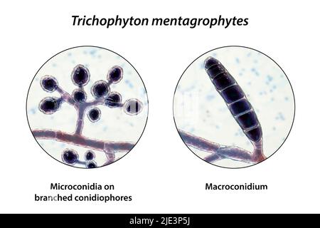 Pilze Trichophyton mentagrophytes, die Ursache des Fußes des Athleten (Tinea pedis), des Kopfhautringwurms (Tinea capitus) und der Nagelinfektion (Onychomykose), Illustration. T. mentagrophytes ist eine von vielen Pilzarten, die in der menschlichen Haut wachsen und Entzündungen und Juckreiz verursachen können. Fußpilz, Ringwurm und Onychomykose werden mit Antimykotika behandelt. Die Abbildung zeigt zwei Arten von Konidien (Strukturen, die Pilzsporen enthalten, die Infektionen übertragen): Verzweigte Konidiophoren mit sphärischen Mikrokonidien (einzellige Körper) und Makrokonidium (vielzelliger Körper). Stockfoto