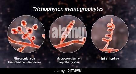 Pilze Trichophyton mentagrophytes, die Ursache des Fußes des Athleten (Tinea pedis), des Kopfhautringwurms (Tinea capitus) und der Nagelinfektion (Onychomykose), Illustration. T. mentagrophytes ist eine von vielen Pilzarten, die in der menschlichen Haut wachsen und Entzündungen und Juckreiz verursachen können. Fußpilz, Ringwurm und Onychomykose werden mit Antimykotika behandelt. Die Abbildung zeigt zwei Arten von Konidien (Strukturen, die Pilzsporen enthalten, die Infektionen übertragen): Verzweigte Konidiophoren mit sphärischen Mikrokonidien (einzellige Körper), Makrokonidium (vielzelliger Körper) und Spiralhyphen. Stockfoto