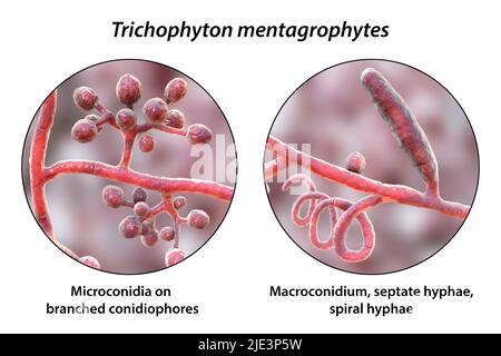 Pilze Trichophyton mentagrophytes, die Ursache des Fußes des Athleten (Tinea pedis), des Kopfhautringwurms (Tinea capitus) und der Nagelinfektion (Onychomykose), Illustration. T. mentagrophytes ist eine von vielen Pilzarten, die in der menschlichen Haut wachsen und Entzündungen und Juckreiz verursachen können. Fußpilz, Ringwurm und Onychomykose werden mit Antimykotika behandelt. Die Abbildung zeigt zwei Arten von Konidien (Strukturen, die Pilzsporen enthalten, die Infektionen übertragen): Verzweigte Konidiophoren mit sphärischen Mikrokonidien (einzellige Körper), Makrokonidium (vielzelliger Körper) und Spiralhyphen. Stockfoto