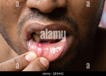 Nahaufnahme eines Mundgeschwürs eines indischen Mannes Stockfoto